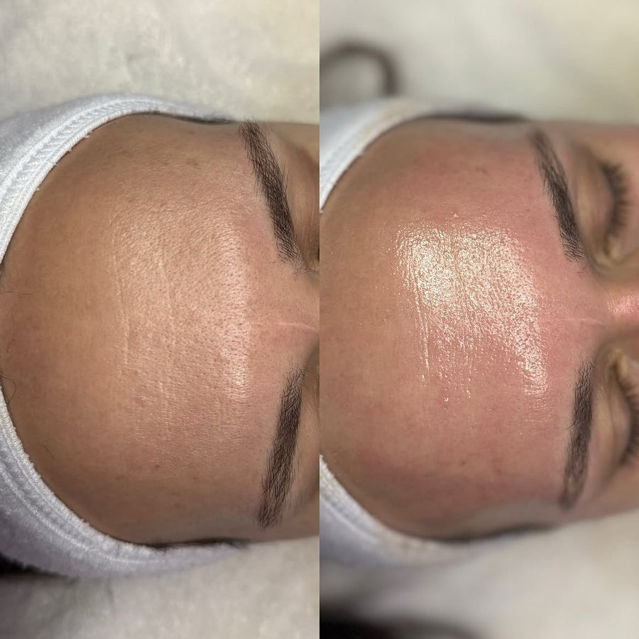 Antes y después de Hydrafacial SOLER – frente