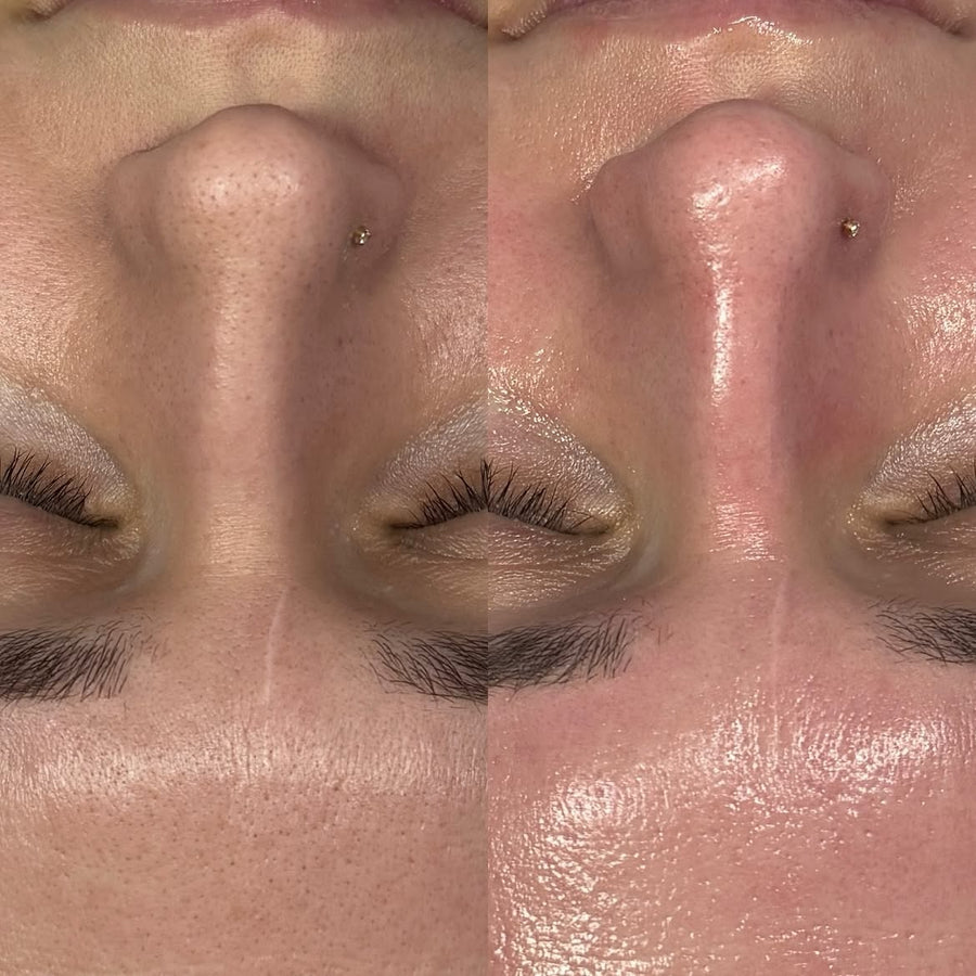 Antes y después de Hydrafacial SOLER – nariz y mejillas