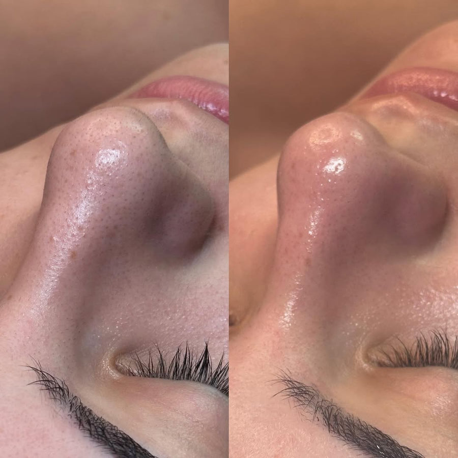 Antes y después de Hydrafacial SOLER – nariz
