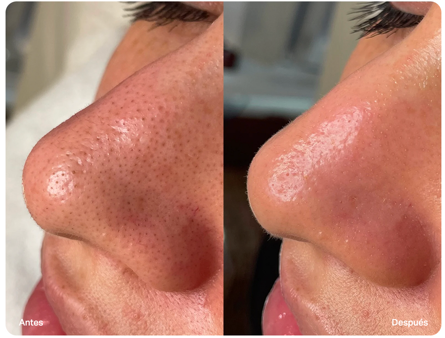 Antes y después de Hydrafacial SOLER – poros de la nariz