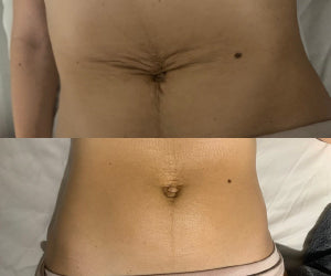 Antes y después masajes post parto SOLER